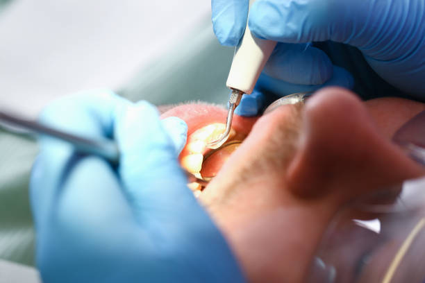 Best Emergency Wisdom Teeth Removal in Continental, OH